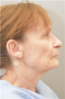 Facelift Before Photo by Keshav Magge, MD; Bethesda, MD - Case 31648