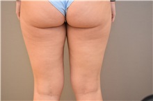 Liposuction Before Photo by Keshav Magge, MD; Bethesda, MD - Case 31655