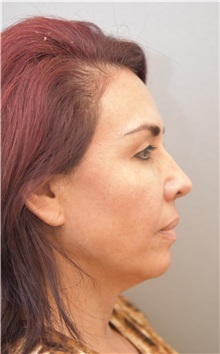 Facelift Before Photo by Keshav Magge, MD; Bethesda, MD - Case 31664