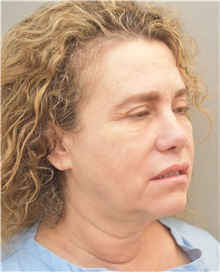 Facelift Before Photo by Keshav Magge, MD; Bethesda, MD - Case 31665