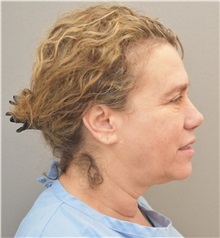 Facelift Before Photo by Keshav Magge, MD; Bethesda, MD - Case 31665