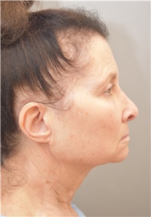 Facelift Before Photo by Keshav Magge, MD; Bethesda, MD - Case 31666