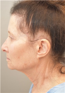 Facelift Before Photo by Keshav Magge, MD; Bethesda, MD - Case 31666