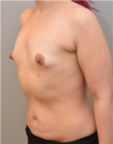 Breast Augmentation Before Photo by Keshav Magge, MD; Bethesda, MD - Case 31687
