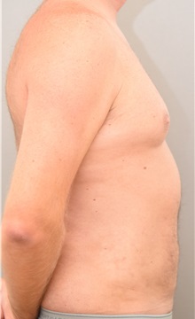 Liposuction After Photo by Keshav Magge, MD; Bethesda, MD - Case 31693