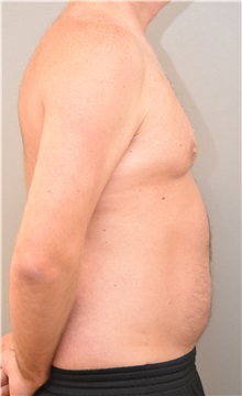 Liposuction Before Photo by Keshav Magge, MD; Bethesda, MD - Case 31693