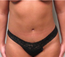 Tummy Tuck After Photo by Keshav Magge, MD; Bethesda, MD - Case 31694