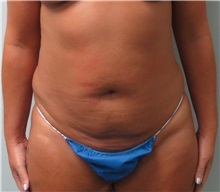 Tummy Tuck Before Photo by Keshav Magge, MD; Bethesda, MD - Case 31694