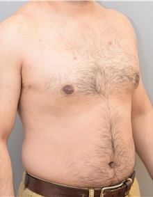 Male Breast Reduction After Photo by Keshav Magge, MD; Bethesda, MD - Case 31814
