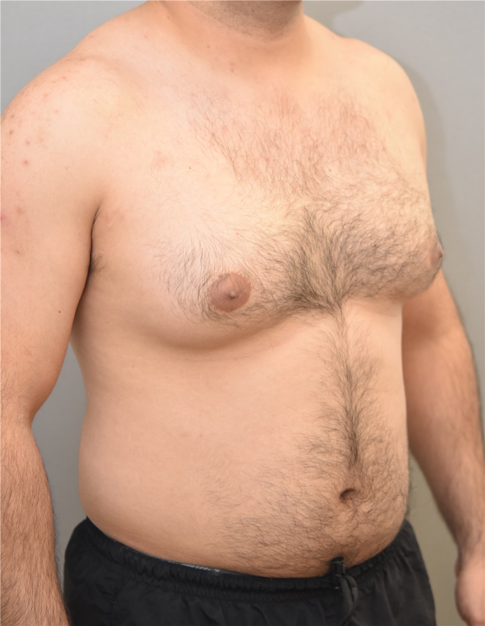 Male Breast Reduction Before and After Photos by Keshav Magge, MD; Bethesda,  MD - Case 31814