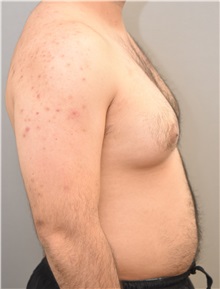 Male Breast Reduction Before Photo by Keshav Magge, MD; Bethesda, MD - Case 31814