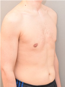 Male Breast Reduction After Photo by Keshav Magge, MD; Bethesda, MD - Case 31815