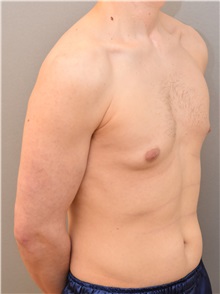 Male Breast Reduction Before Photo by Keshav Magge, MD; Bethesda, MD - Case 31815