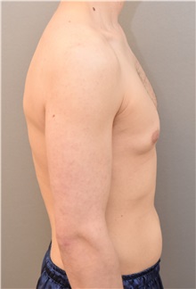 Male Breast Reduction Before Photo by Keshav Magge, MD; Bethesda, MD - Case 31815