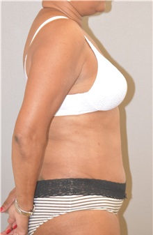 Tummy Tuck After Photo by Keshav Magge, MD; Bethesda, MD - Case 31817
