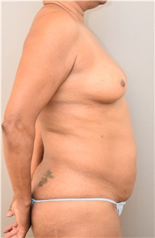 Tummy Tuck Before Photo by Keshav Magge, MD; Bethesda, MD - Case 31817