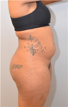 Buttock Lift with Augmentation Before Photo by Keshav Magge, MD; Bethesda, MD - Case 31819