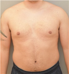 Male Breast Reduction Before Photo by Keshav Magge, MD; Bethesda, MD - Case 31919