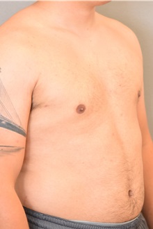 Male Breast Reduction After Photo by Keshav Magge, MD; Bethesda, MD - Case 31919