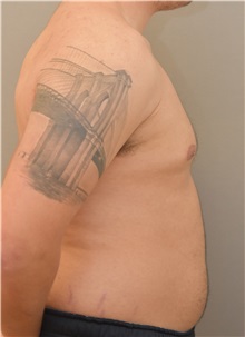 Male Breast Reduction Before Photo by Keshav Magge, MD; Bethesda, MD - Case 31919