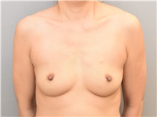 Breast Augmentation Before Photo by Keshav Magge, MD; Bethesda, MD - Case 32106