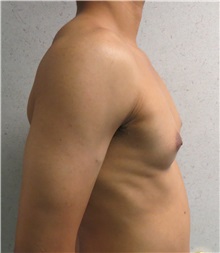 Male Breast Reduction Before Photo by Keshav Magge, MD; Bethesda, MD - Case 32107