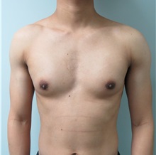Male Breast Reduction After Photo by Keshav Magge, MD; Bethesda, MD - Case 32107