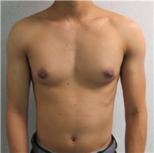 Male Breast Reduction Before Photo by Keshav Magge, MD; Bethesda, MD - Case 32107