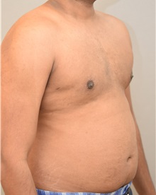 Male Breast Reduction After Photo by Keshav Magge, MD; Bethesda, MD - Case 32109