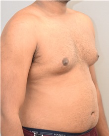 Male Breast Reduction Before Photo by Keshav Magge, MD; Bethesda, MD - Case 32109