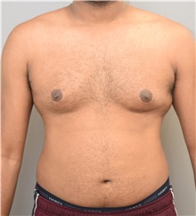 Male Breast Reduction Before Photo by Keshav Magge, MD; Bethesda, MD - Case 32109