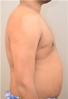 Male Breast Reduction After Photo by Keshav Magge, MD; Bethesda, MD - Case 32109