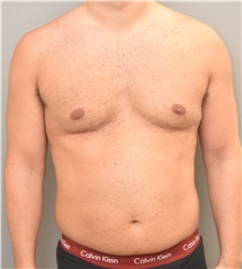 Liposuction Before Photo by Keshav Magge, MD; Bethesda, MD - Case 32226