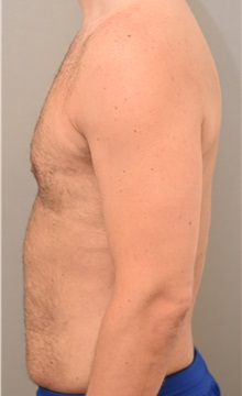 Liposuction After Photo by Keshav Magge, MD; Bethesda, MD - Case 32226