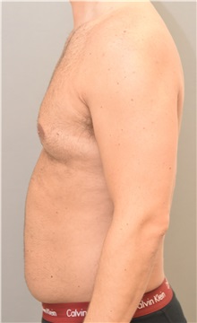 Liposuction Before Photo by Keshav Magge, MD; Bethesda, MD - Case 32226