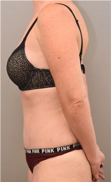 Tummy Tuck After Photo by Keshav Magge, MD; Bethesda, MD - Case 32233