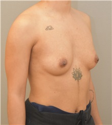 Breast Augmentation Before Photo by Keshav Magge, MD; Bethesda, MD - Case 32526
