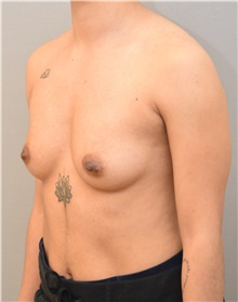 Breast Augmentation Before Photo by Keshav Magge, MD; Bethesda, MD - Case 32526