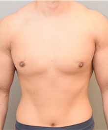 Male Breast Reduction After Photo by Keshav Magge, MD; Bethesda, MD - Case 32863