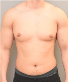 Male Breast Reduction Before Photo by Keshav Magge, MD; Bethesda, MD - Case 32863