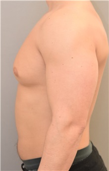 Male Breast Reduction Before Photo by Keshav Magge, MD; Bethesda, MD - Case 32863