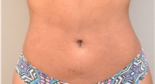 Liposuction After Photo by Keshav Magge, MD; Bethesda, MD - Case 32864