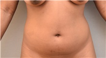 Liposuction Before Photo by Keshav Magge, MD; Bethesda, MD - Case 32864
