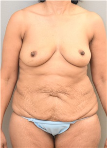 Tummy Tuck Before Photo by Keshav Magge, MD; Bethesda, MD - Case 33258