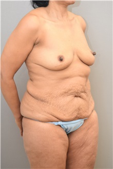 Tummy Tuck Before Photo by Keshav Magge, MD; Bethesda, MD - Case 33258