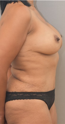 Tummy Tuck After Photo by Keshav Magge, MD; Bethesda, MD - Case 33258