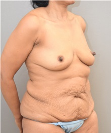 Breast Augmentation Before Photo by Keshav Magge, MD; Bethesda, MD - Case 33259