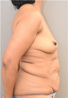 Breast Augmentation Before Photo by Keshav Magge, MD; Bethesda, MD - Case 33259