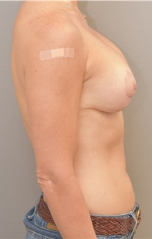 Breast Lift After Photo by Keshav Magge, MD; Bethesda, MD - Case 33488