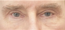 Eyelid Surgery After Photo by Keshav Magge, MD; Bethesda, MD - Case 36856